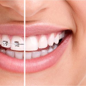ortodontia-dentale-center