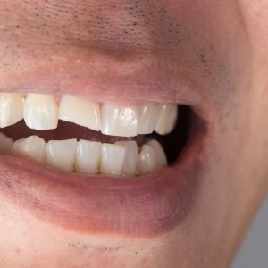 Teeth Injuries or Teeth Breaking in Male. Trauma and Nerve Damage of injured tooth, Permanent Teeth Injury.