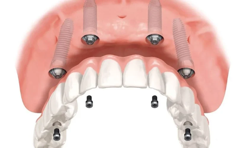 all-on-four-quatro-implantes-dentarios