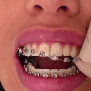 interromper-tratamento-o-ortodontico-e1575651127849