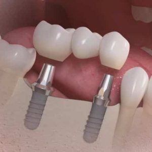 ponte_fixa_sobre_implantes_50kb-2e0a459c