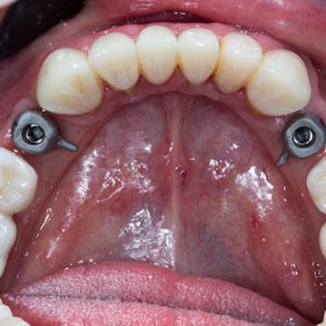 protese-sobre-implantes
